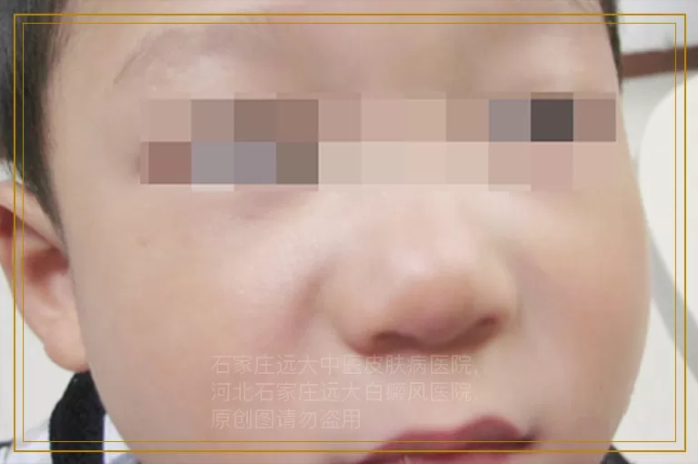 宝宝胸口出现一片白斑是怎么回事