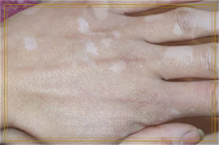 7岁儿子生殖器长白癜风能激光吗