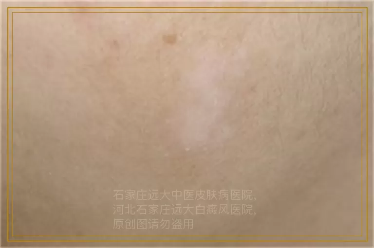 5岁儿童头皮一小块白是白癜风吗