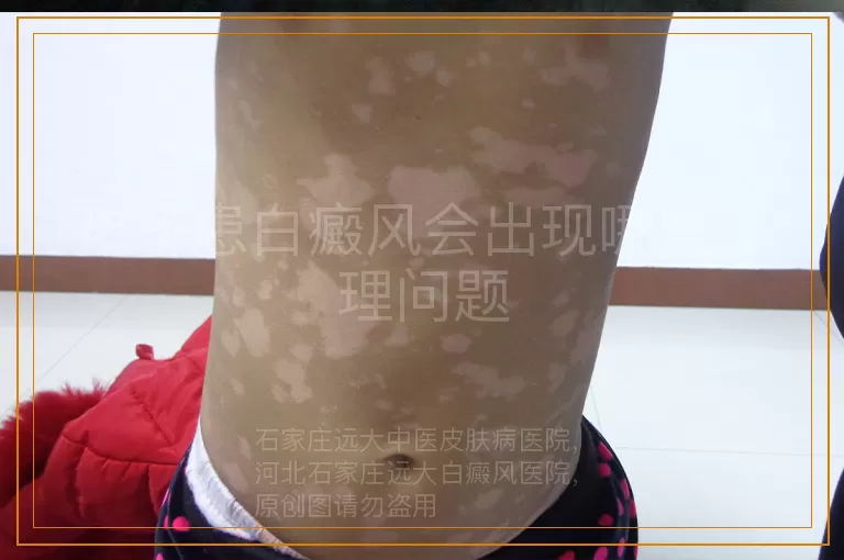 孩子患白癜风会出现哪些心理问题