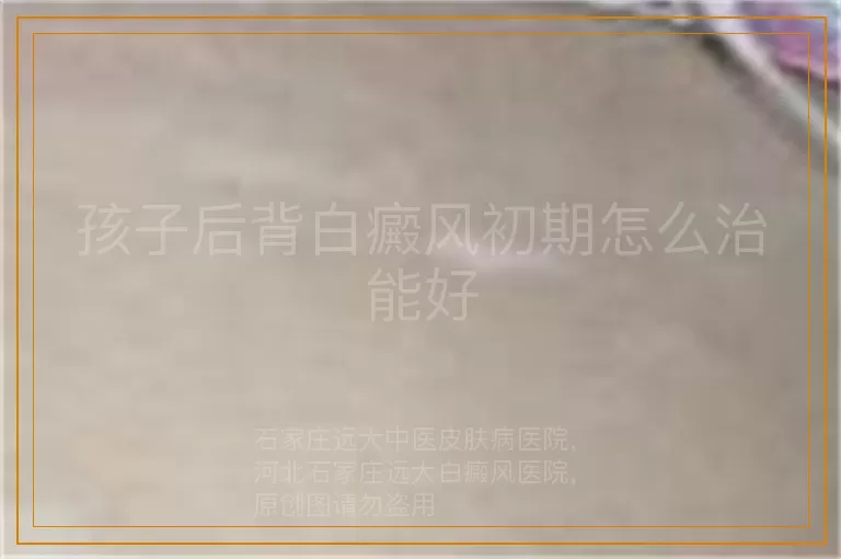 孩子后背白癜风初期怎么治能好