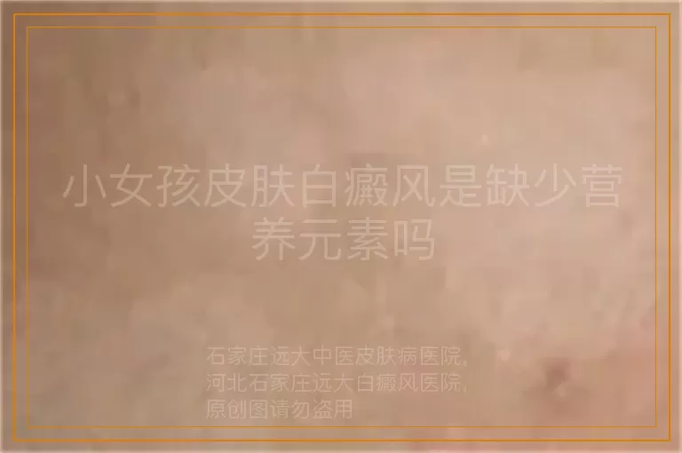 小女孩皮肤白癜风是缺少营养元素吗