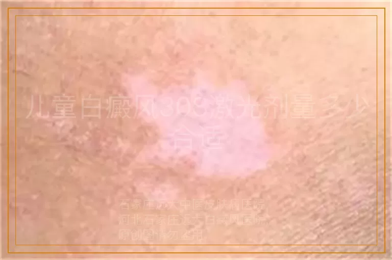儿童白癜风308激光剂量多少合适