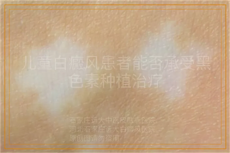 儿童白癜风患者能否承受黑色素种植治疗