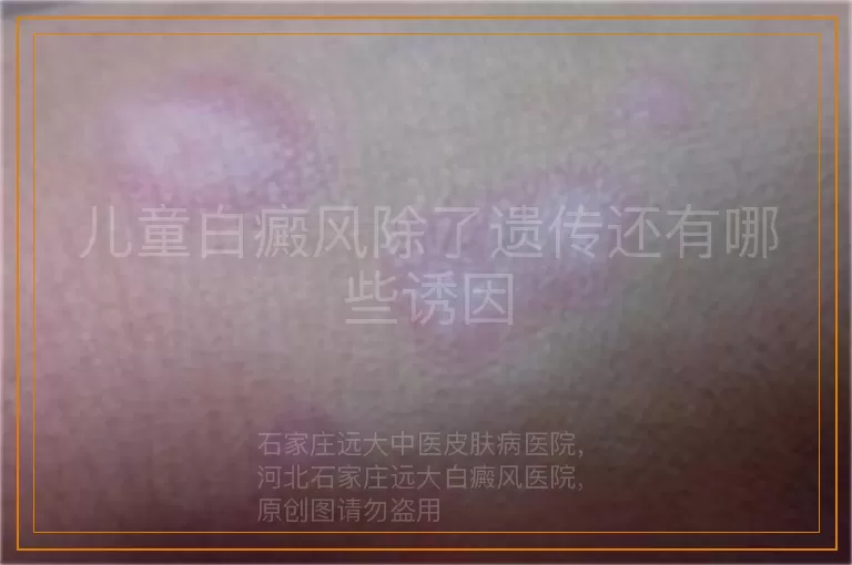 儿童白癜风除了遗传还有哪些诱因