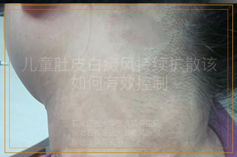 儿童肚皮白癜风持续扩散该如何有效控制