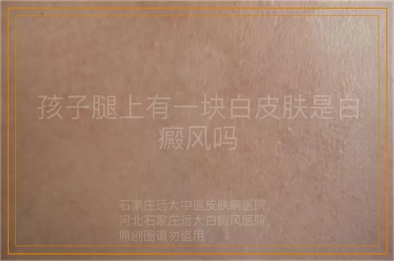 孩子腿上有一块白皮肤是白癜风吗