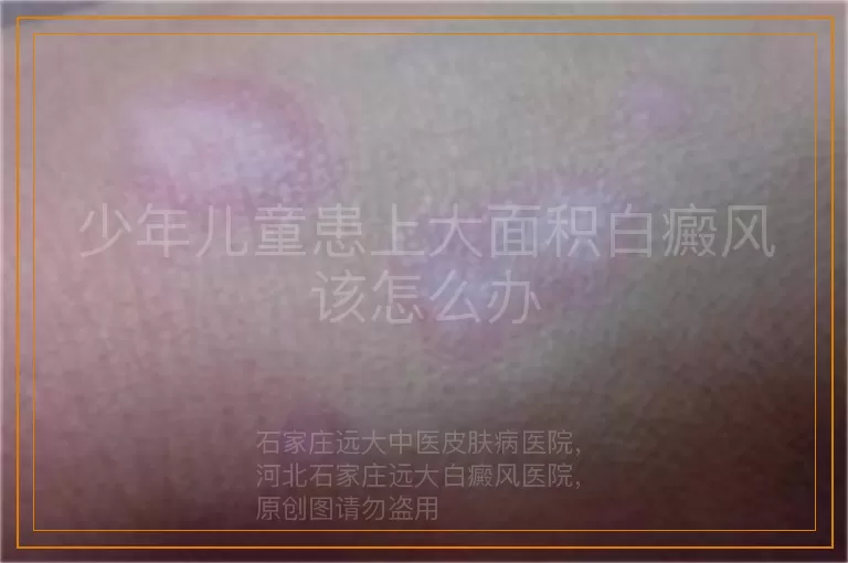 少年儿童患上大面积白癜风该怎么办