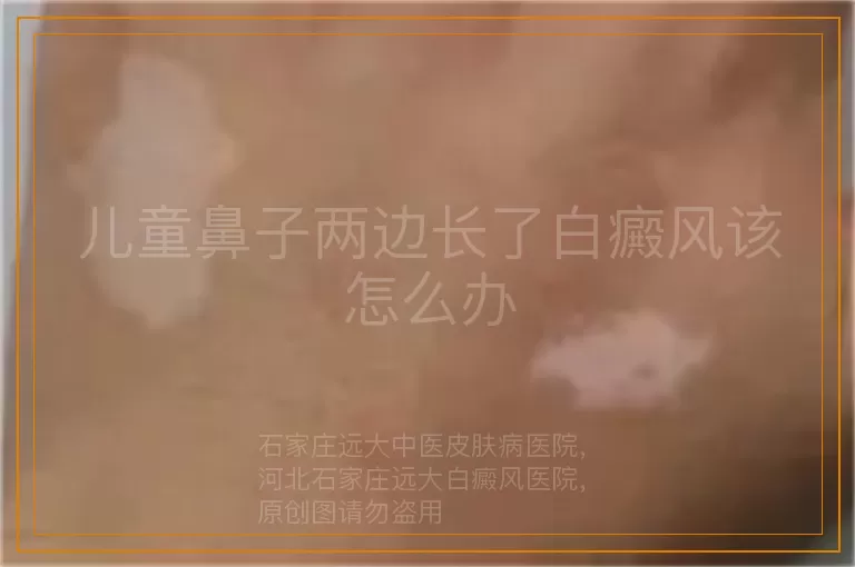 儿童鼻子两边长了白癜风该怎么办