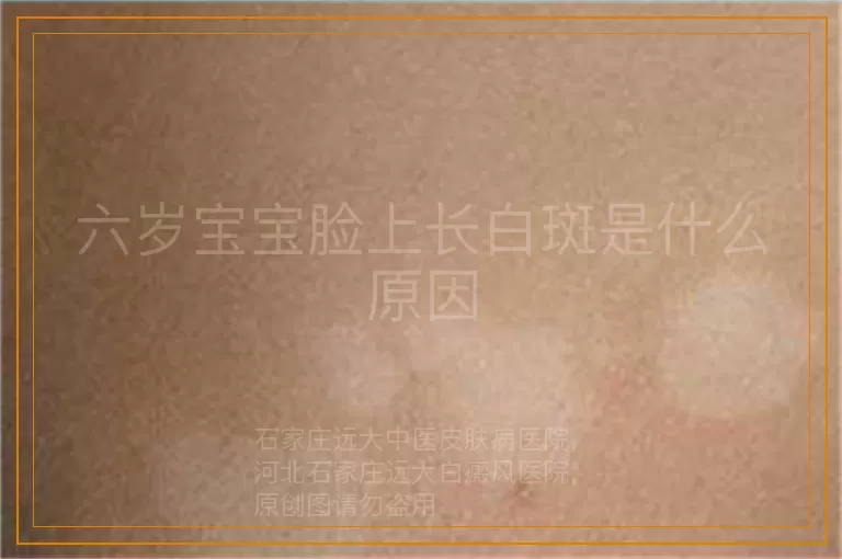 六岁宝宝脸上长白斑是什么原因