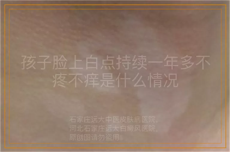 孩子脸上白点持续一年多不疼不痒是什么情况