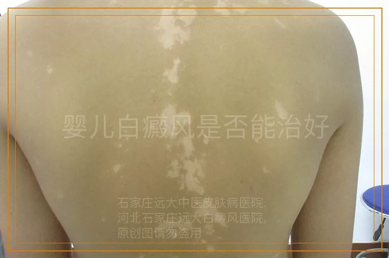 婴儿白癜风是否能治好