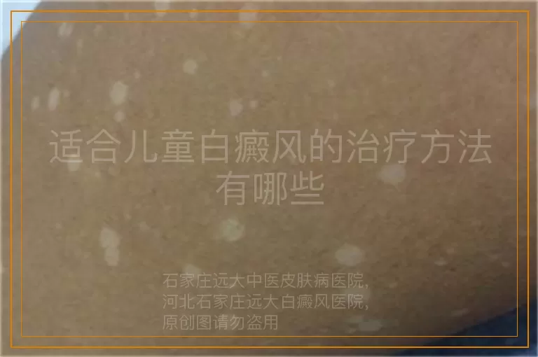 适合儿童白癜风的治疗方法有哪些