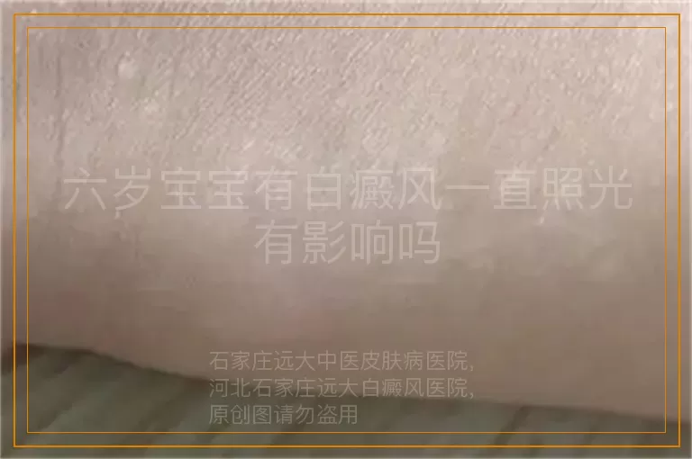 六岁宝宝有白癜风一直照光有影响吗