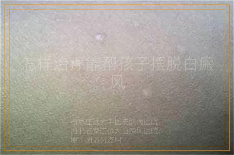 怎样治疗能帮孩子摆脱白癜风