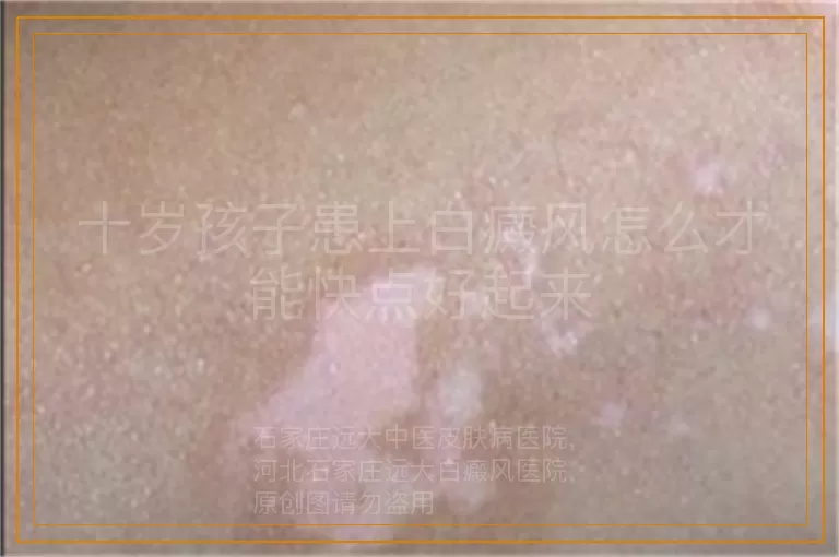 十岁孩子患上白癜风怎么才能快点好起来