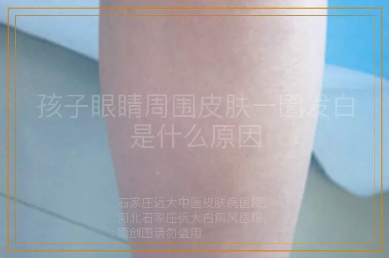 孩子眼睛周围皮肤一圈发白是什么原因