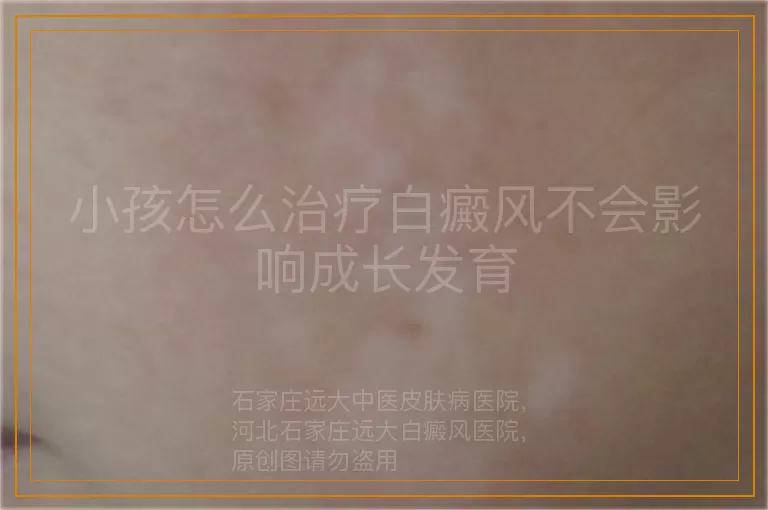 小孩怎么治疗白癜风不会影响成长发育