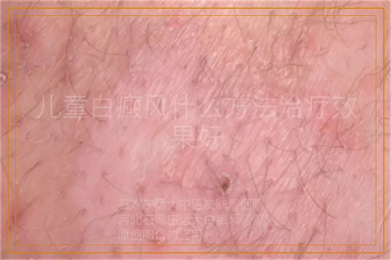 儿童白癜风什么方法治疗效果好