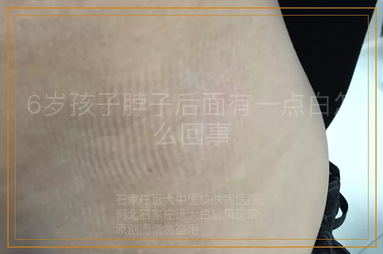 6岁孩子脖子后面有一点白怎么回事