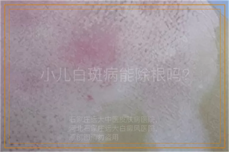 小儿白斑病能除根吗？