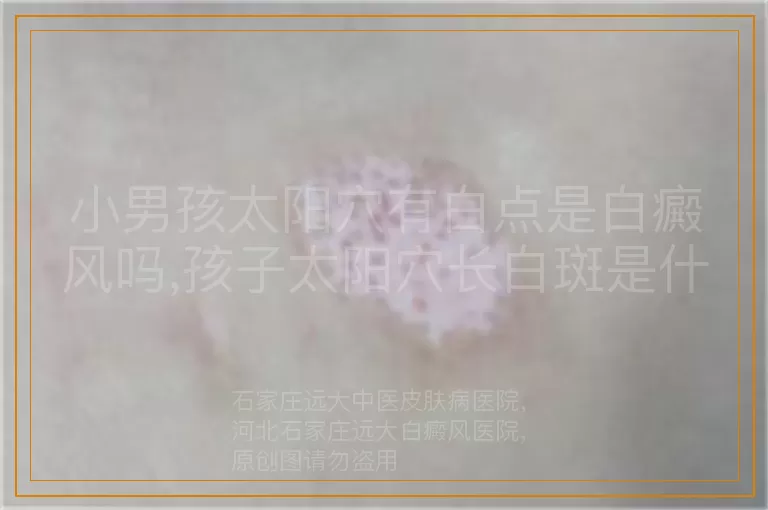 小男孩太阳穴有白点是白癜风吗,孩子太阳穴长白斑是什么原因,儿童太阳穴出现白点是不是白癜风