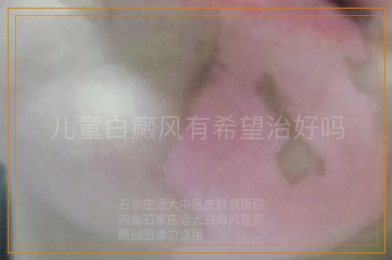 儿童白癜风有希望治好吗