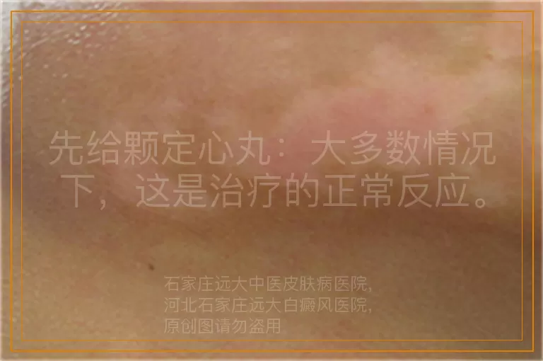 先给颗定心丸：大多数情况下，这是治疗的正常反应。