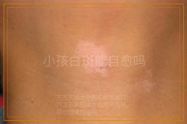小孩白斑能自愈吗