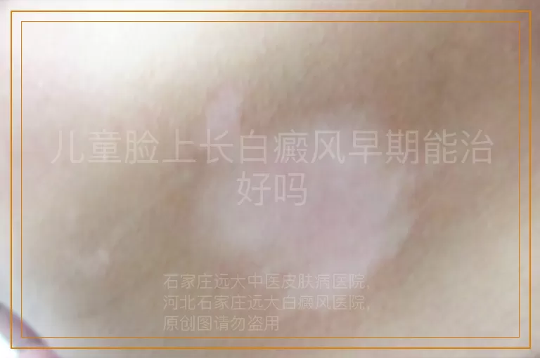 儿童脸上长白癜风早期能治好吗