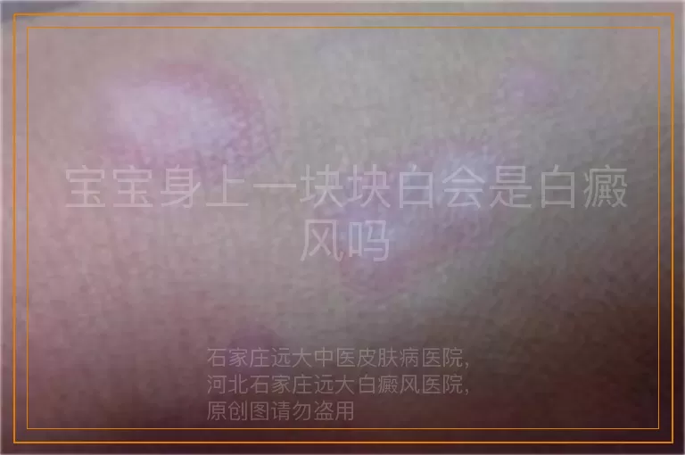 宝宝身上一块块白会是白癜风吗