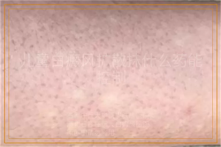 儿童白癜风扩散抹什么药能控制