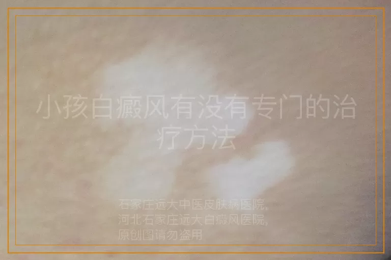小孩白癜风有没有专门的治疗方法