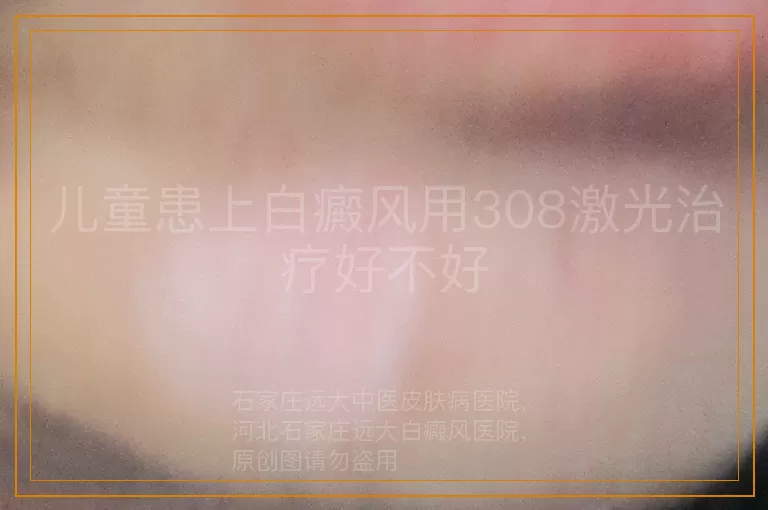 儿童患上白癜风用308激光治疗好不好
