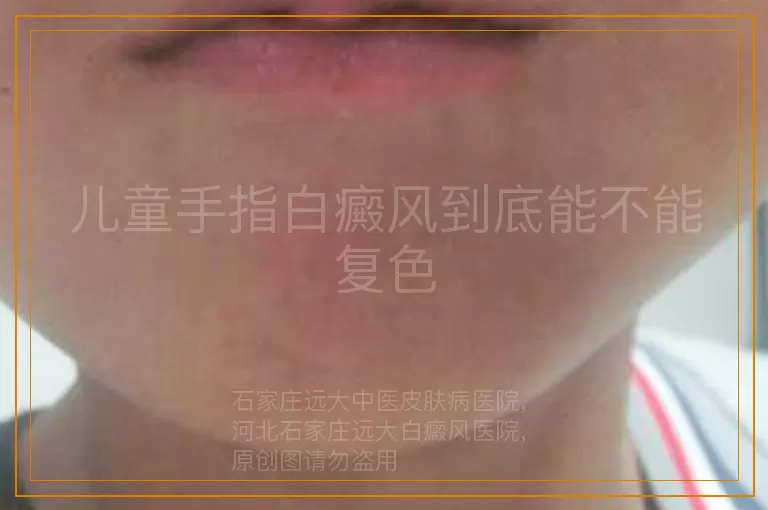 儿童手指白癜风到底能不能复色