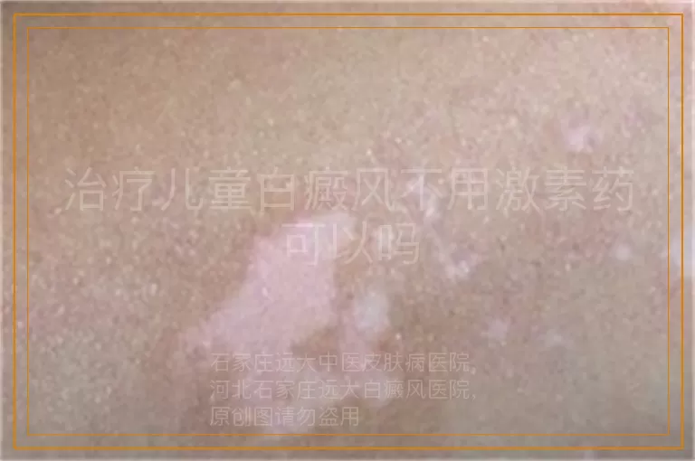 治疗儿童白癜风不用激素药可以吗
