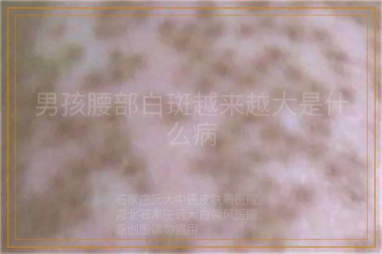 男孩腰部白斑越来越大是什么病