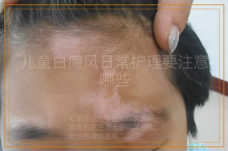 儿童白癜风日常护理要注意哪些
