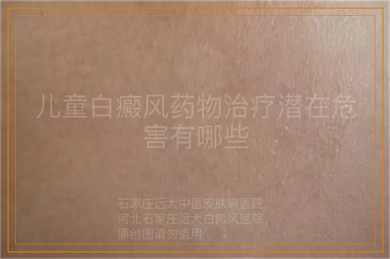 儿童白癜风药物治疗潜在危害有哪些