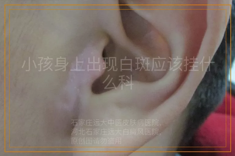 小孩身上出现白斑应该挂什么科