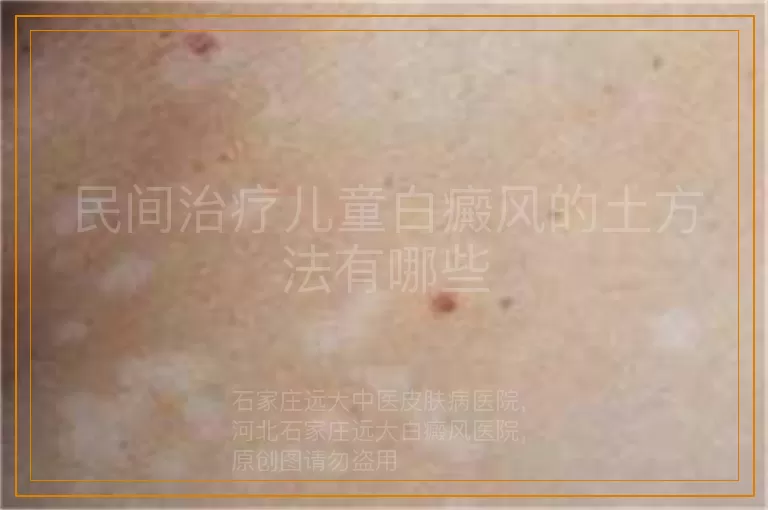 民间治疗儿童白癜风的土方法有哪些