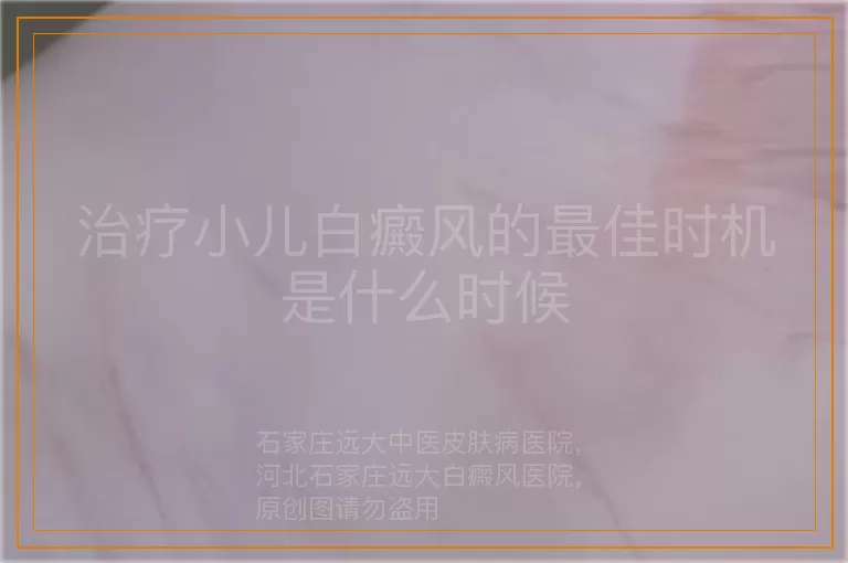 治疗小儿白癜风的最佳时机是什么时候