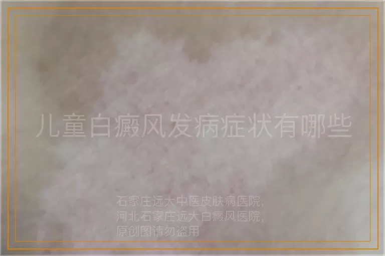 儿童白癜风发病症状有哪些