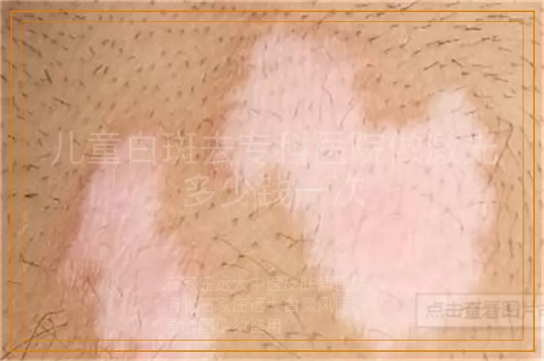 儿童白斑去专科医院做激光多少钱一次