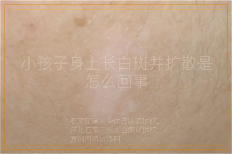 小孩子身上长白斑并扩散是怎么回事