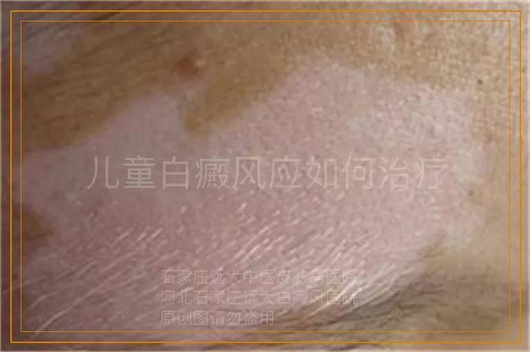 儿童白癜风应如何治疗