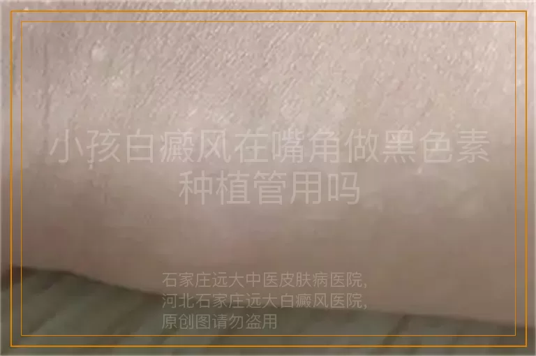 小孩白癜风在嘴角做黑色素种植管用吗
