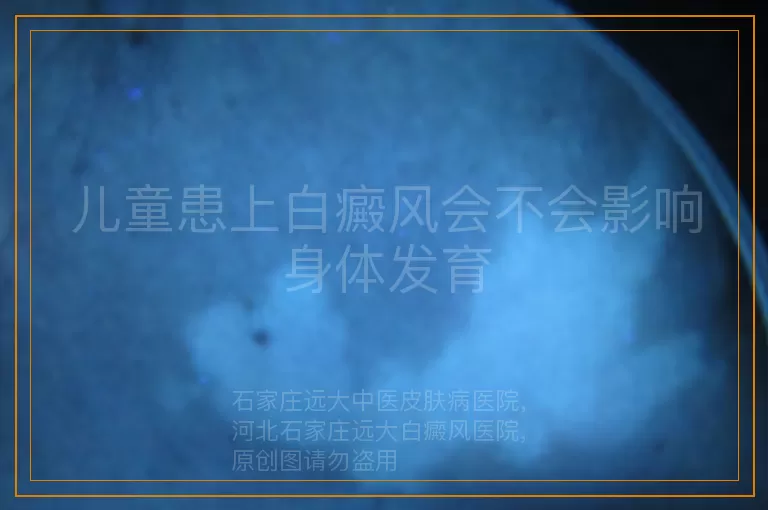 儿童患上白癜风会不会影响身体发育