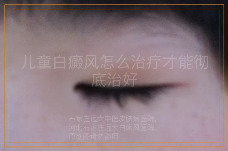 儿童白癜风怎么治疗才能彻底治好