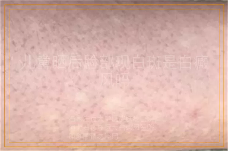 儿童晒后脸部现白斑是白癜风吗
